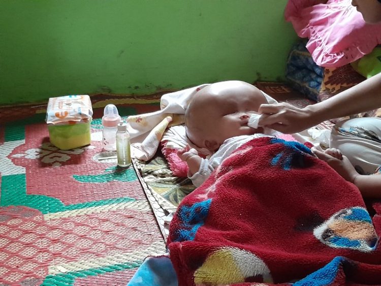 Bayi yang mengidap penyakit lengka/Katasumbar.com