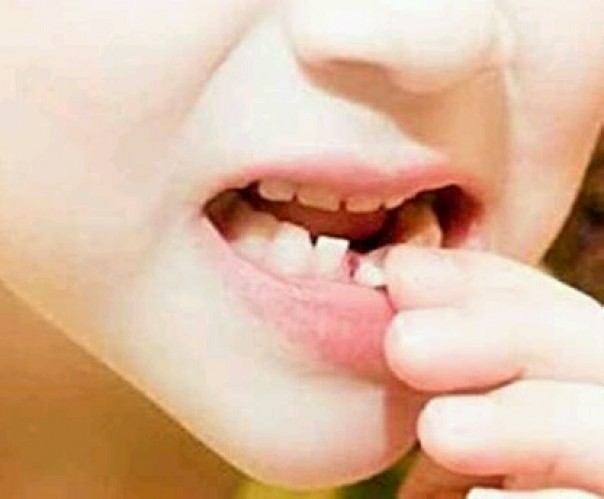 Mimpi Gigi Copot Apakah Pertanda Keluarga Dekat Akan Meninggal, Beginilah  Menurut Pakar Mimpi | Riau1.Com