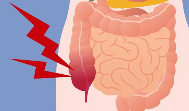 Usus Buntu/ilustrasi