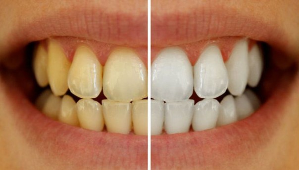 Ilustrasi gigi kuning dan putih setelah dibersihkan. 