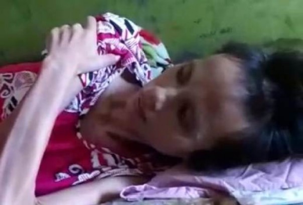 Dewi, warga Perawang yang mengidap tumor usus selama 1,5 tahun butuh uluran tangan