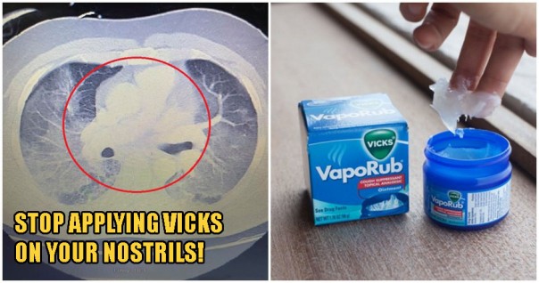 Rutin Menghirup Vicks VaporRub Saat Flu, Pria Malaysia Ini Hampir Tewas Mengenaskan 